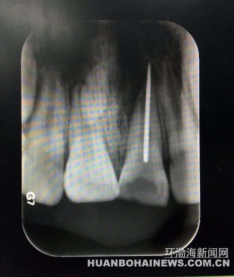 X光片顯示縫衣針扎入牙齒根管。